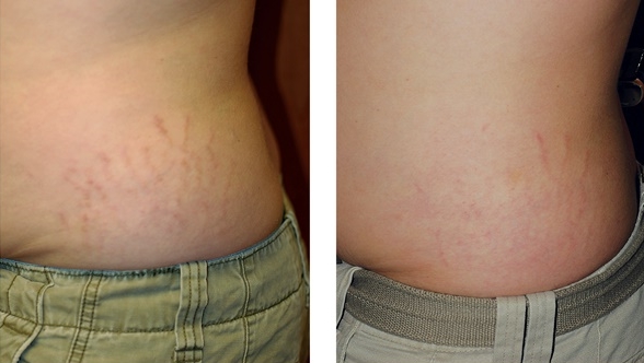 Before Fraxel re:store and 1 month after 3 treatments by J. Waib