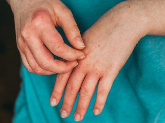 How to Manage Eczema Flare-ups - Fashion Enzyme